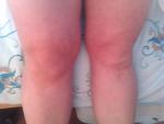 My legs are not pretty that is why I wear trousers but can you spot the swollen knee?